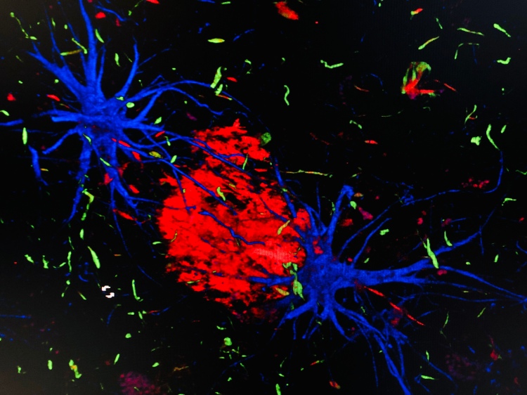 Placa Neurítica bordeada por células gliales