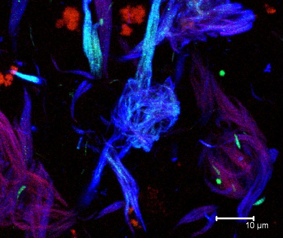 Maraña Neurofibrlar Extracelular teñida con antocuerpos dirigidos contra la proteína tau fosforilada canal verde y azul. contrateñido con el colorante rojo tiazina. corte de hipocampo de un caso con al enfermedad de Alzheimer.